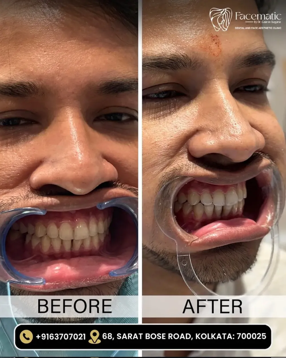 Dental treatment, before and after at Facematic