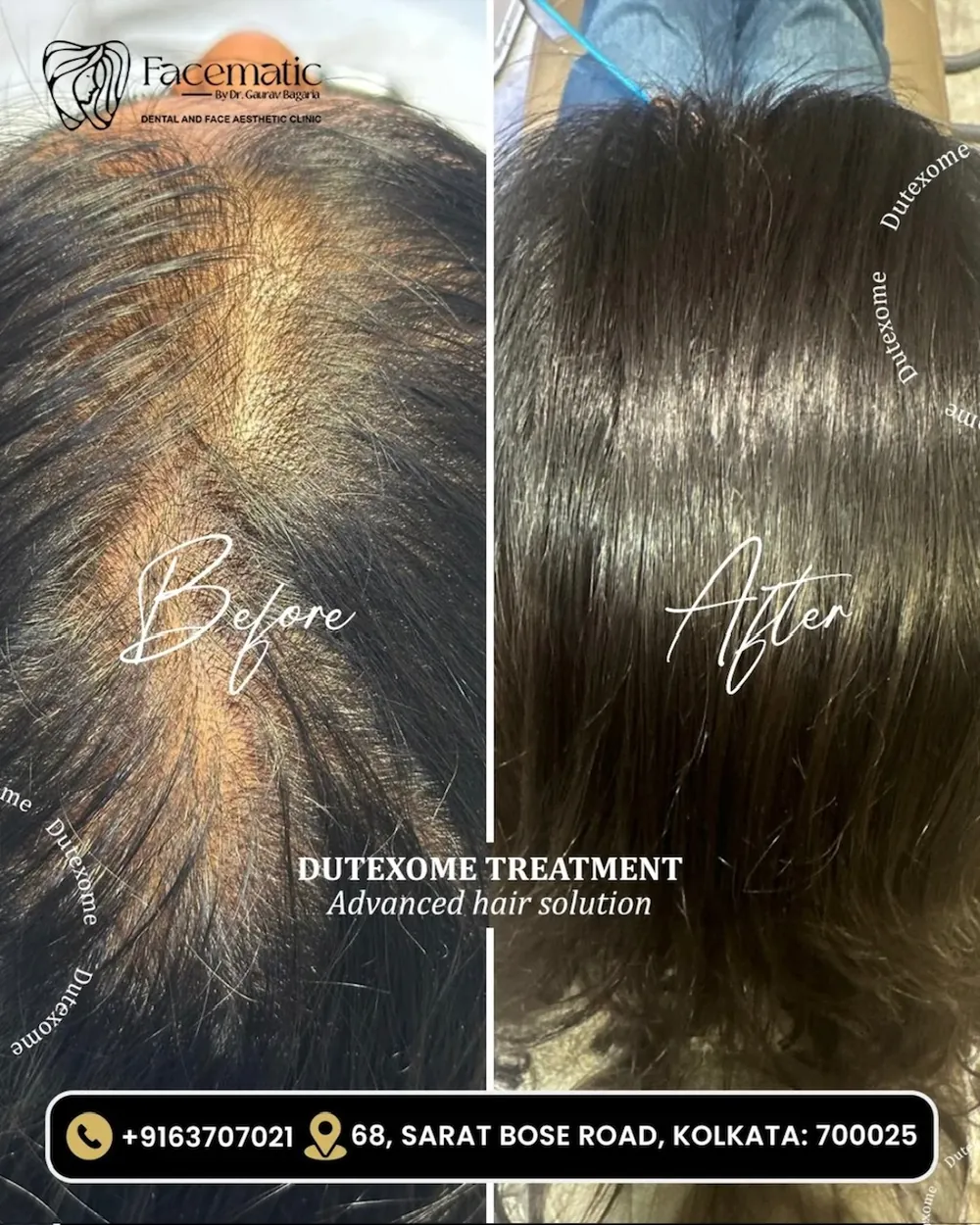 Dutexome hair treatment, before and after at Facematic