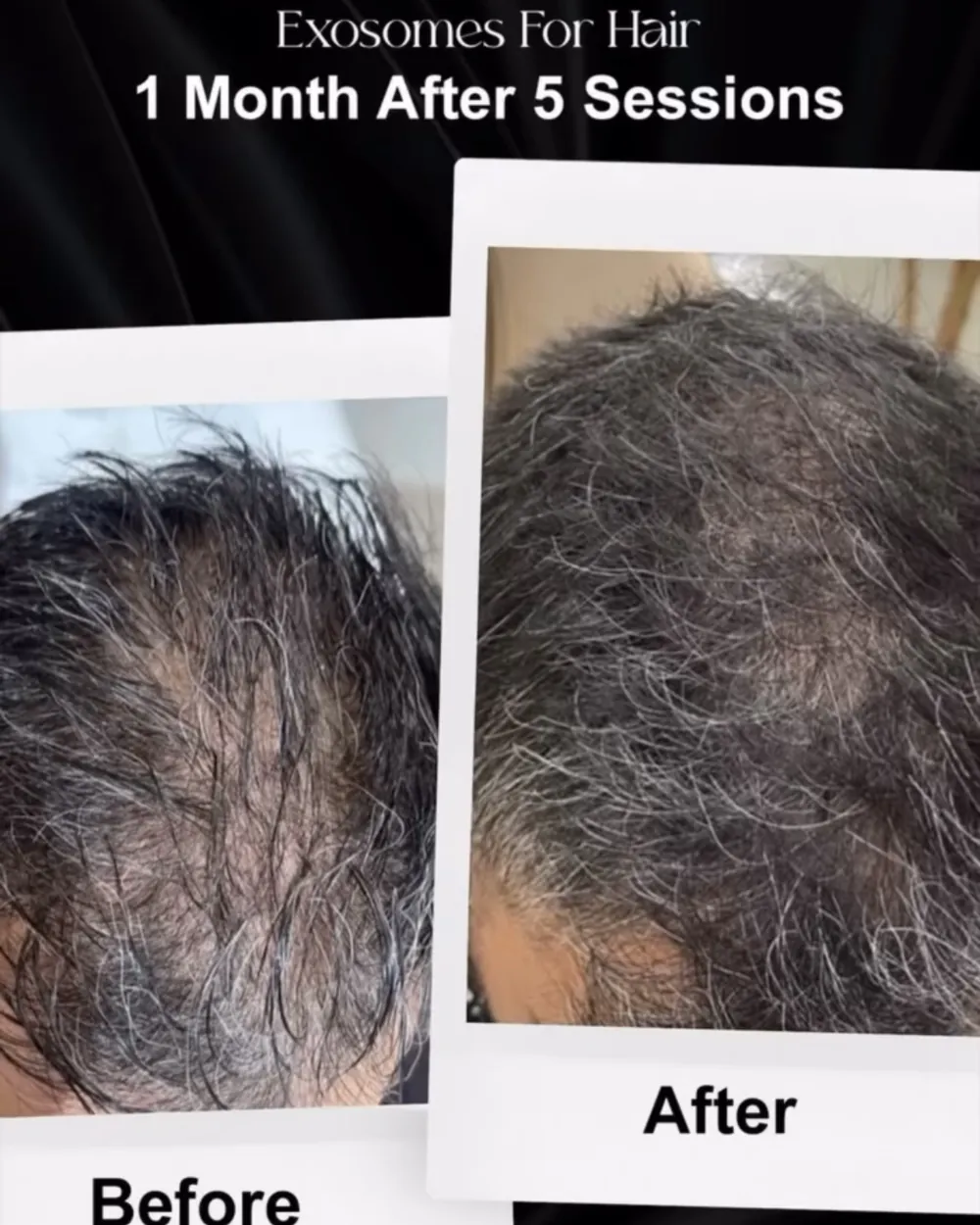 Exosome hair therapy, before and after at Facematic