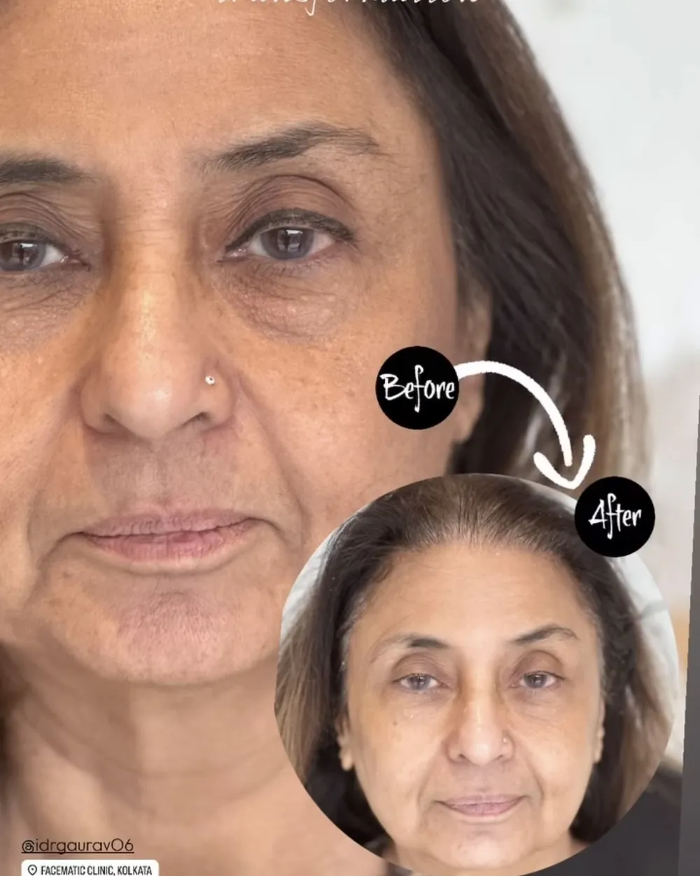 Facial rejuvenation, before and after at Facematic