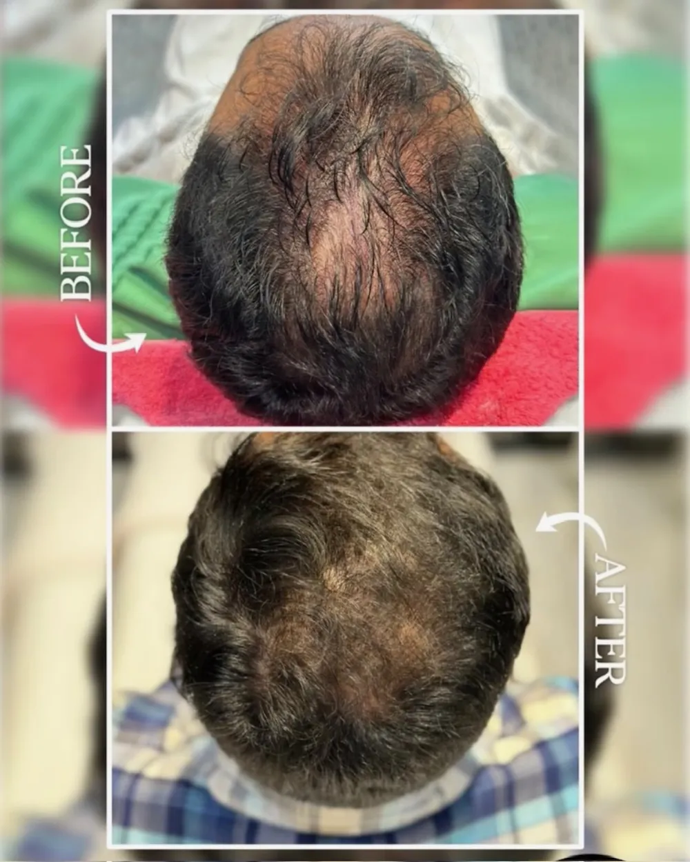 Hair restoration, before and after at Facematic