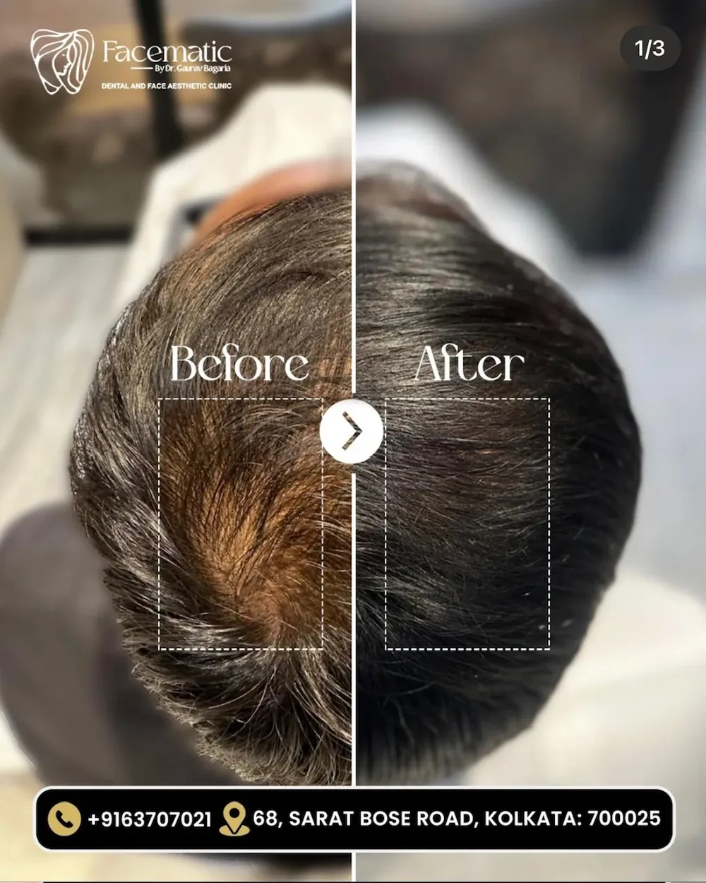 Hair restoration, before and after at Facematic
