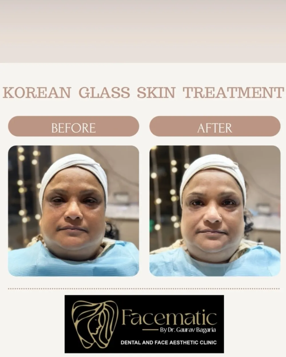 Korean glass skin, before and after at Facematic