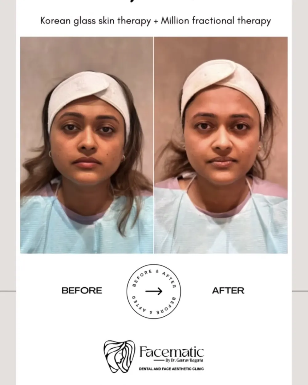 Korean glass skin + fractional therapy, before and after at Facematic