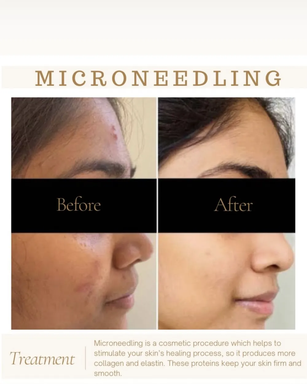 Microneedling, before and after at Facematic