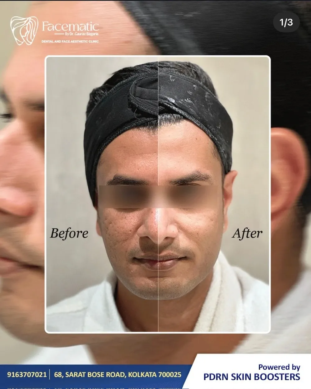 PDRN skin boosters, before and after at Facematic