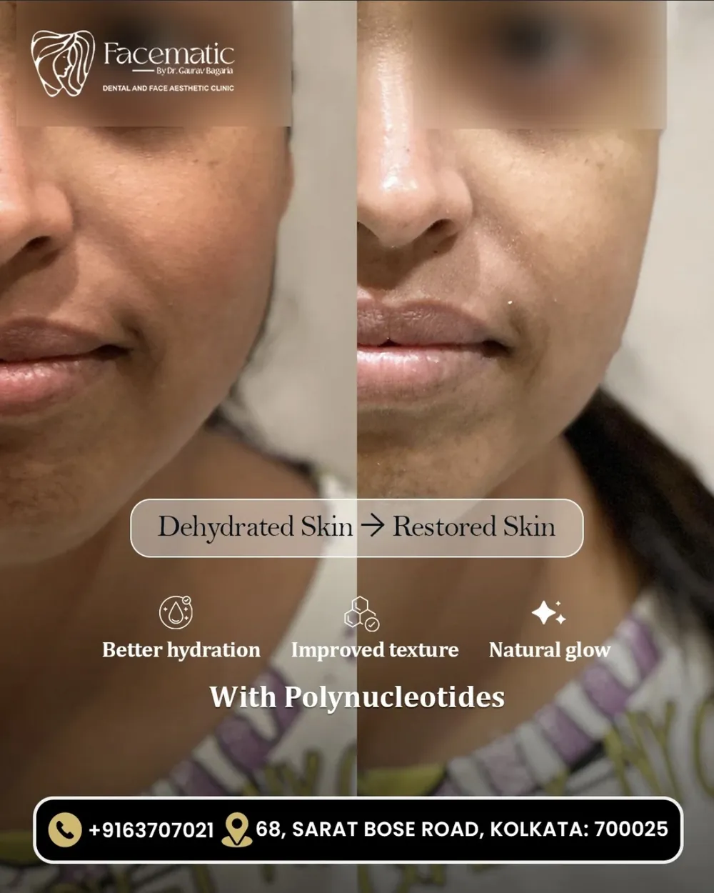 Polynucleotides, before and after at Facematic